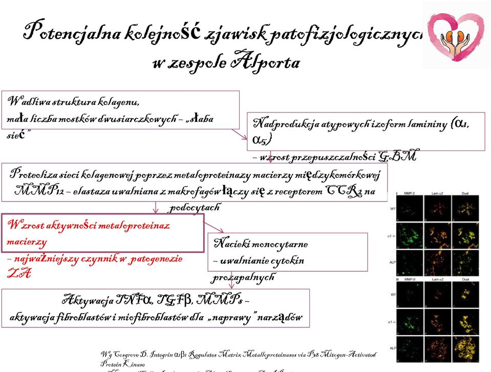 aktywności metaloproteinaz macierzy Nacieki monocytarne najważniejszy niejszy czynnik w patogenezie uwalnianie cytokin ZA prozapalnych Aktywacja TNFα, TGFβ, MMPs aktywacja fibroblastów i