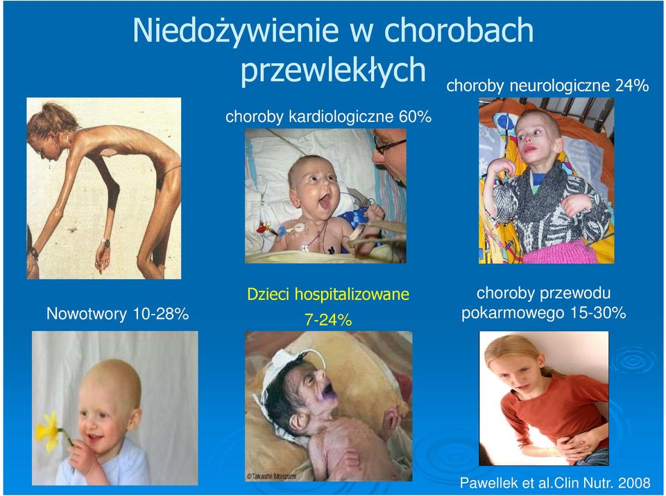 hospitalizowane Nowotwory 10-28% Dzieci hospitalizowane