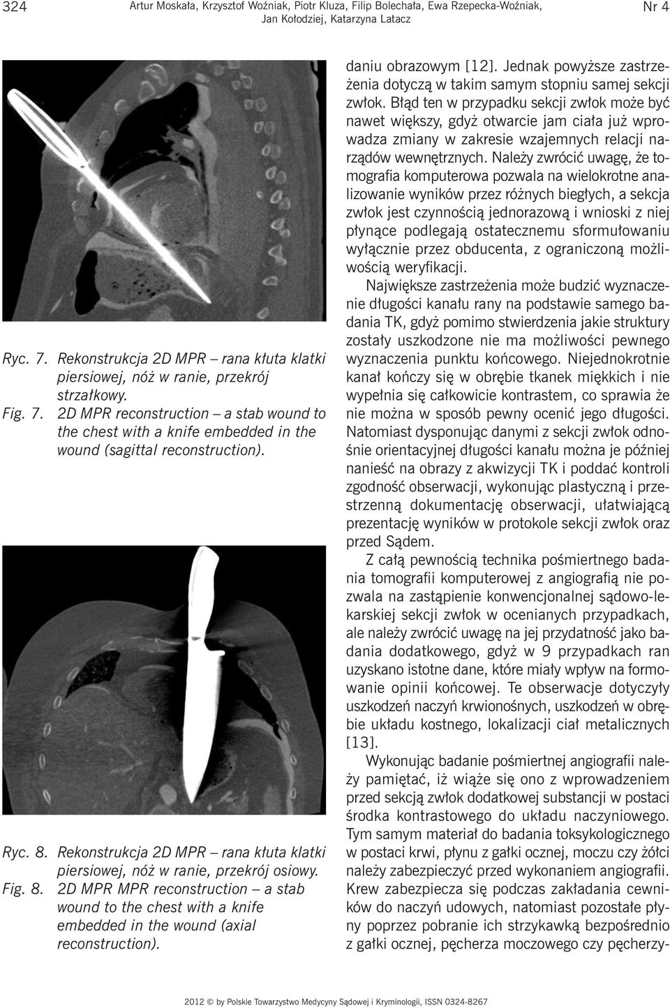 Ryc. 8. Rekonstrukcja 2D MPR rana kłuta klatki piersiowej, nóż w ranie, przekrój osiowy. Fig. 8. 2D MPR MPR reconstruction a stab wound to the with a knife embedded in the wound (axial reconstruction).