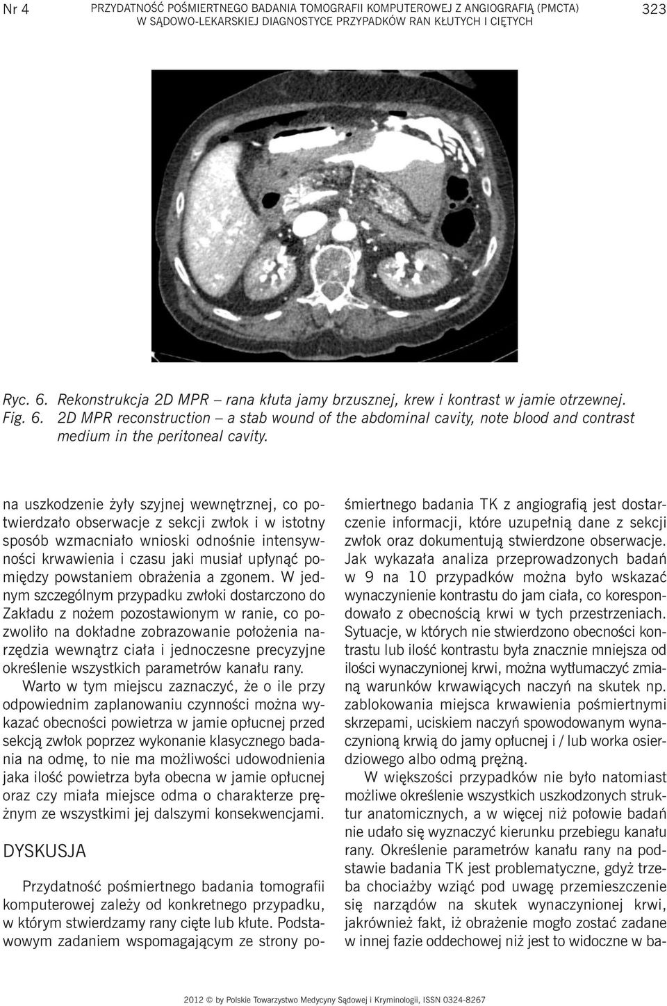 2D MPR reconstruction a stab wound of the abdominal cavity, note blood and contrast medium in the peritoneal cavity.