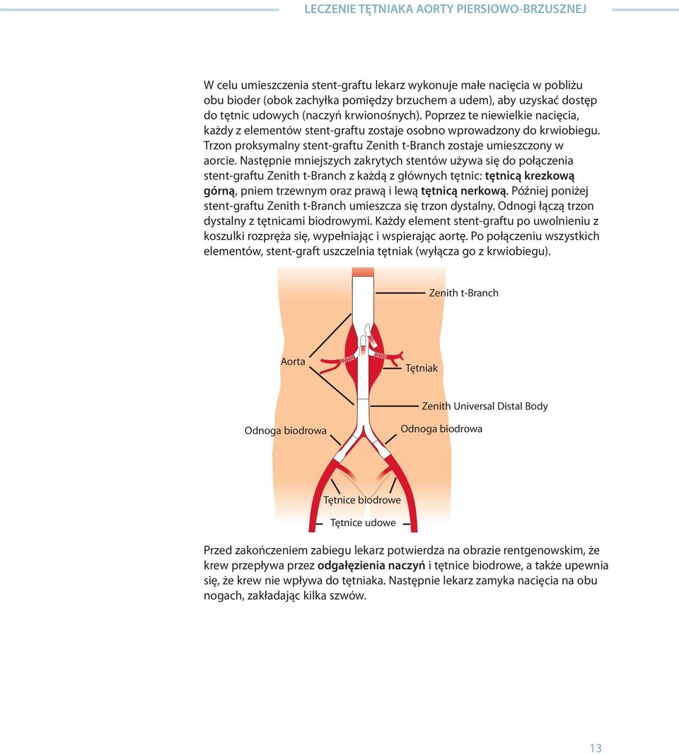 Następnie mniejszych zakrytych stentów używa się do połączenia stent-graftu Zenith t-branch z każdą z głównych tętnic: tętnicą krezkową górną, pniem trzewnym oraz prawą i lewą tętnicą nerkową.