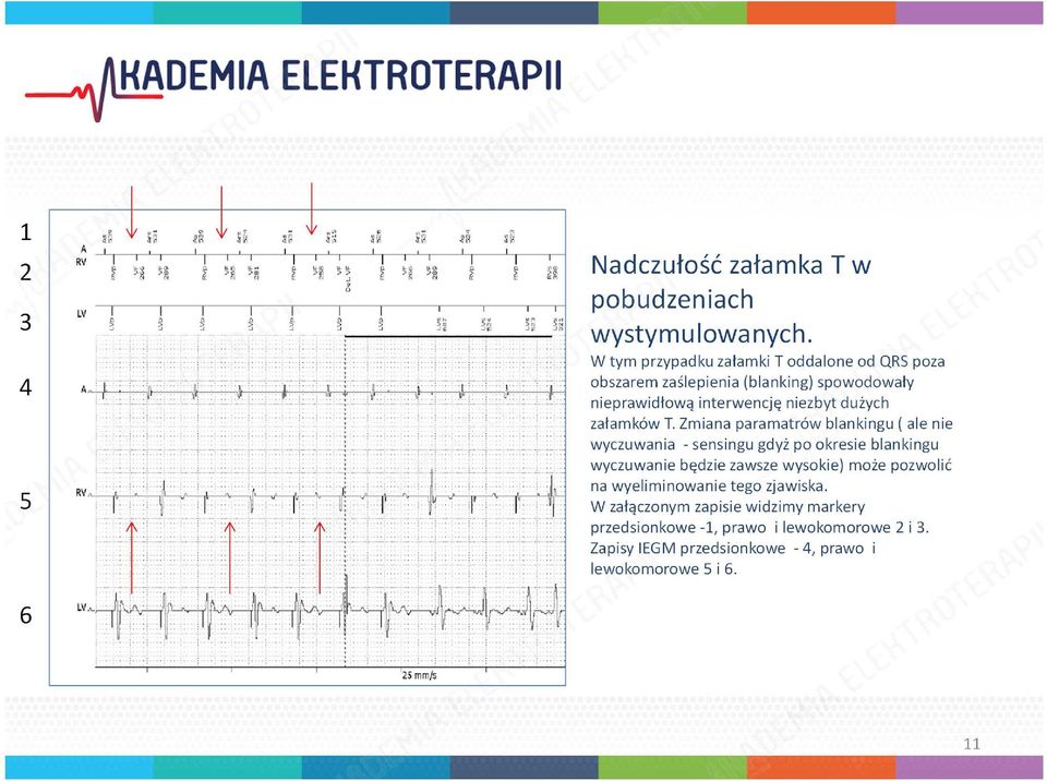 W tym przypadku załamki T oddalone od QRS poza obszarem zaślepienia (blanking) spowodowały nieprawidłową interwencję niezbyt dużych załamków T.