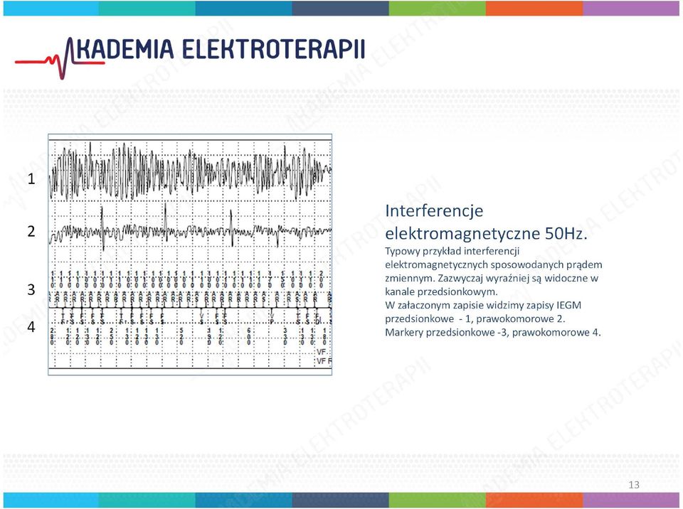 przepony Interferencje pomiędzy elektrodami.