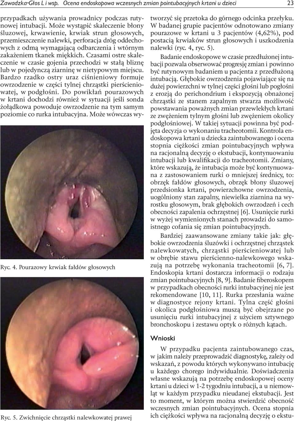 Może wystąpić skaleczenie błony śluzowej, krwawienie, krwiak strun głosowych, przemieszczenie nalewki, perforacja dróg oddechowych z odmą wymagającą odbarczenia i wtórnym zakażeniem tkanek miękkich.