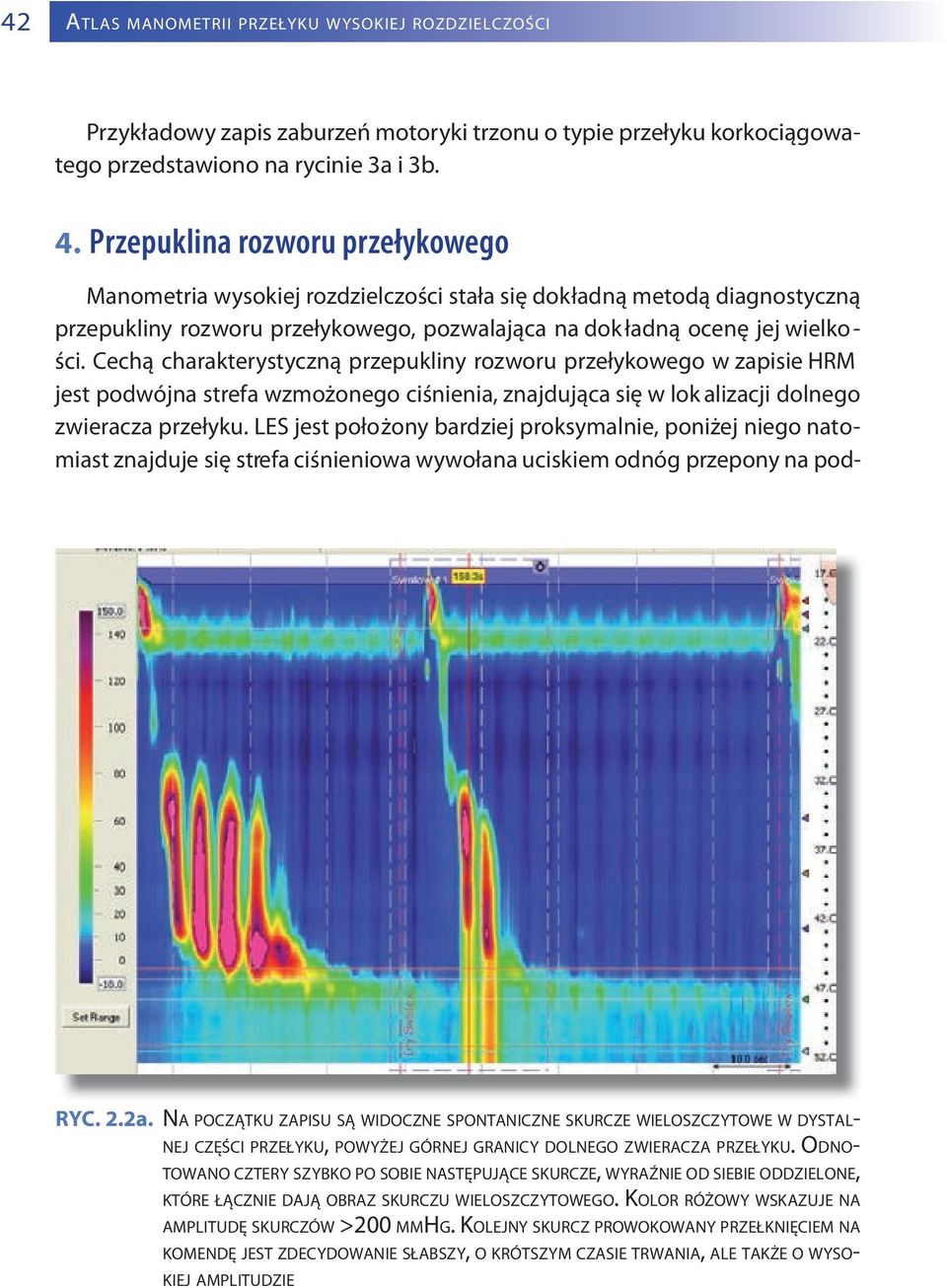 Cechą charakterystyczną przepukliny rozworu przełykowego w zapisie HRM jest podwójna strefa wzmożonego ciśnienia, znajdująca się w lok alizacji dolnego zwieracza przełyku.