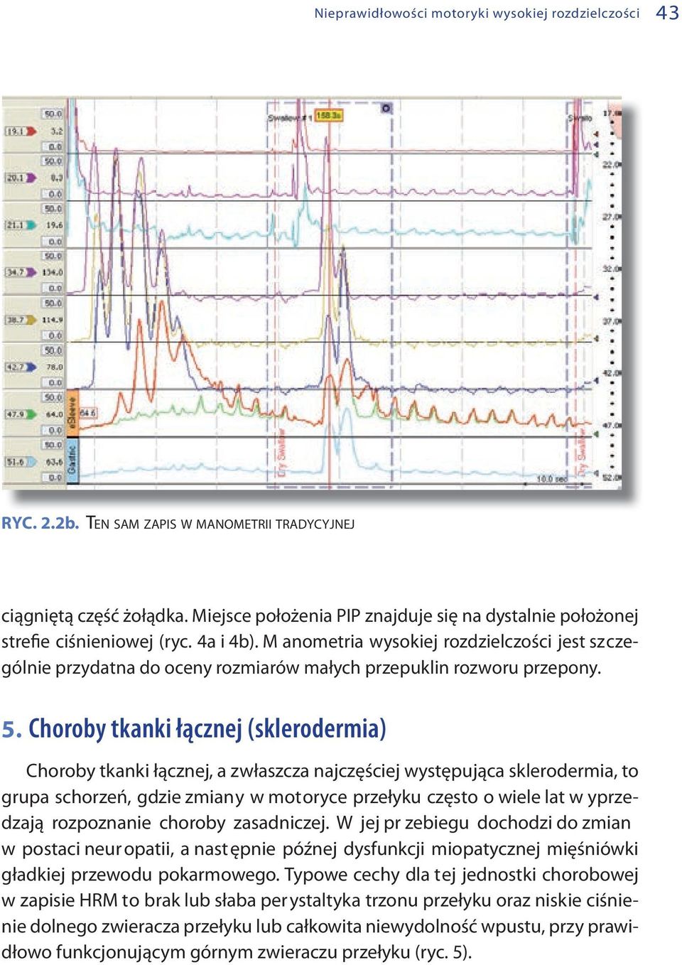 M anometria wysokiej rozdzielczości jest szczególnie przydatna do oceny rozmiarów małych przepuklin rozworu przepony. 5.