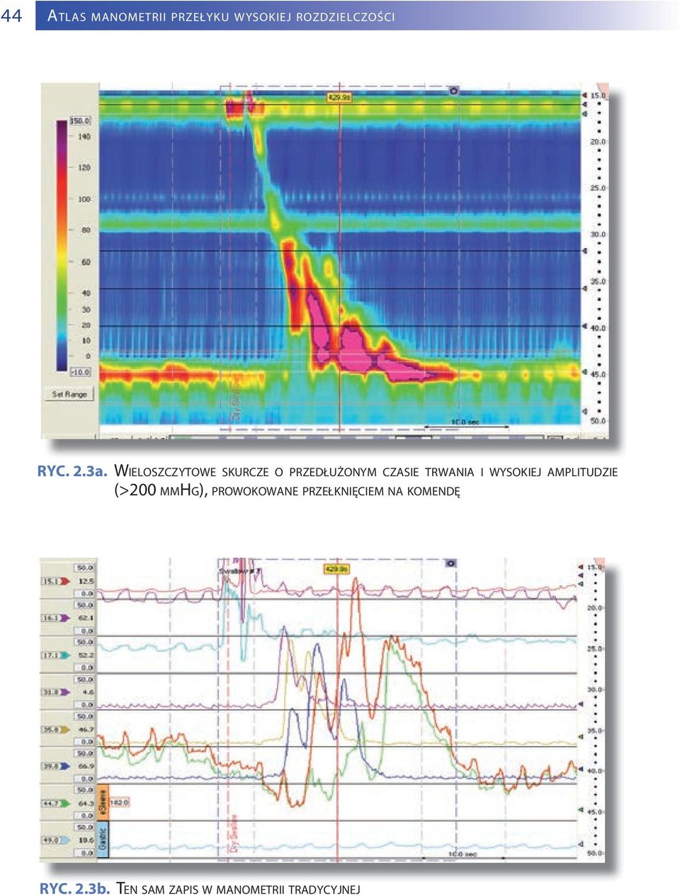 WYSOKIEJ AMPLITUDZIE (>200 MMHG), PROWOKOWANE PRZEŁKNIĘCIEM