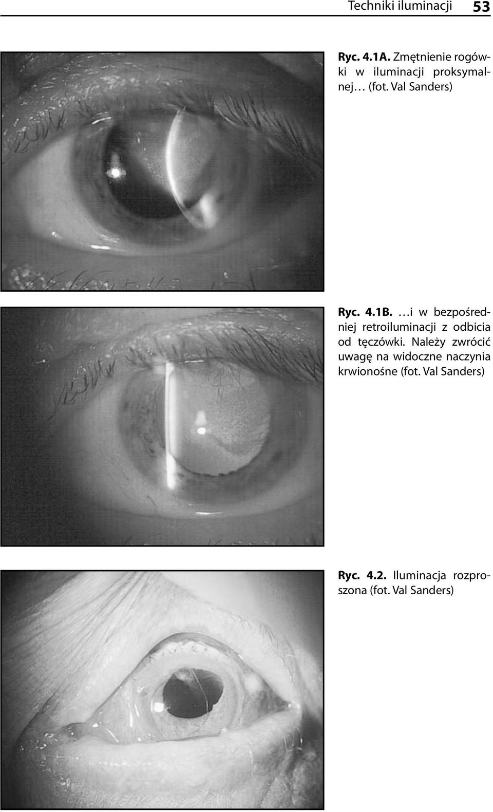 1B. i w bezpośredniej retroiluminacji z odbicia od tęczówki.