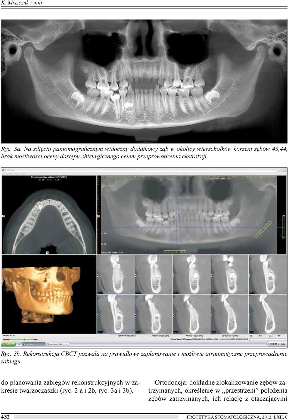 przeprowadzenia ekstrakcji. Ryc. 3b. Rekonstrukcja CBCT pozwala na prawidłowe zaplanowanie i możliwie atraumatyczne przeprowadzenie zabiegu.