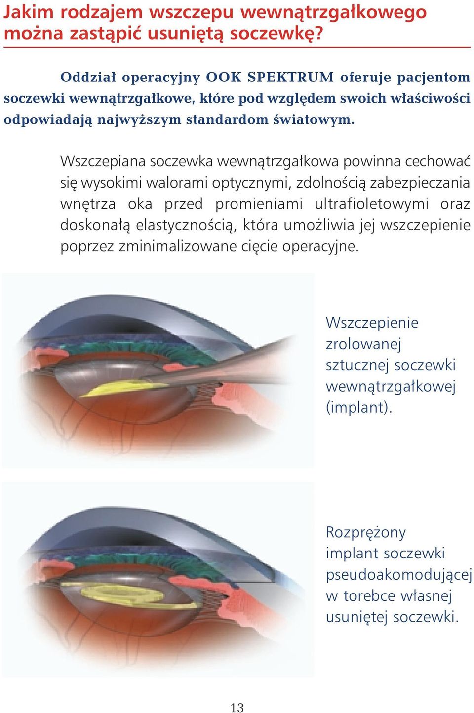 Wszczepiana soczewka wewnàtrzga kowa powinna cechowaç si wysokimi walorami optycznymi, zdolnoêcià zabezpieczania wn trza oka przed promieniami ultrafioletowymi oraz