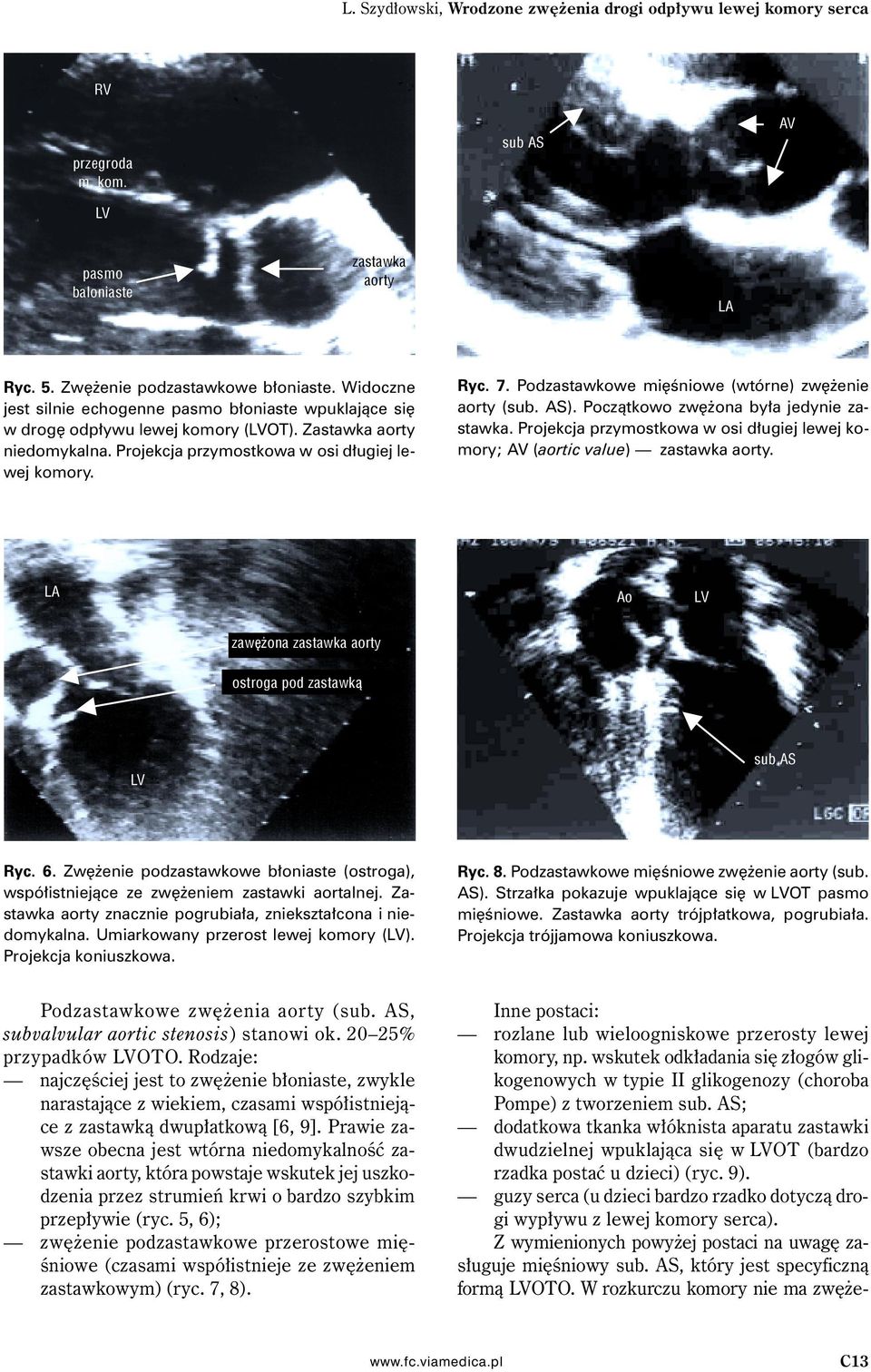Podzastawkowe mięśniowe (wtórne) zwężenie aorty (sub. AS). Początkowo zwężona była jedynie zastawka. Projekcja przymostkowa w osi długiej lewej komory; AV (aortic value) zastawka aorty.