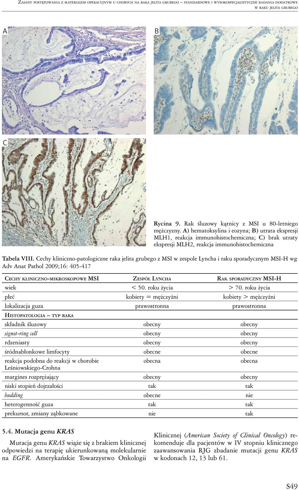 A) hematoksylina i eozyna; B) utrata ekspresji MLH1, reakcja immunohistochemiczna; C) brak utraty ekspresji MLH2, reakcja immunohistochemiczna Tabela VIII.