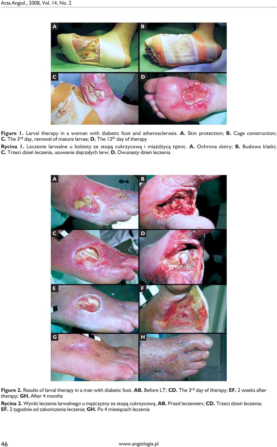 Trzeci dzień leczenia, usuwanie dojrzałych larw; D. Dwunasty dzień leczenia A B C D E F G H Figure 2. Results of larval therapy in a man with diabetic foot. AB. Before LT; CD.