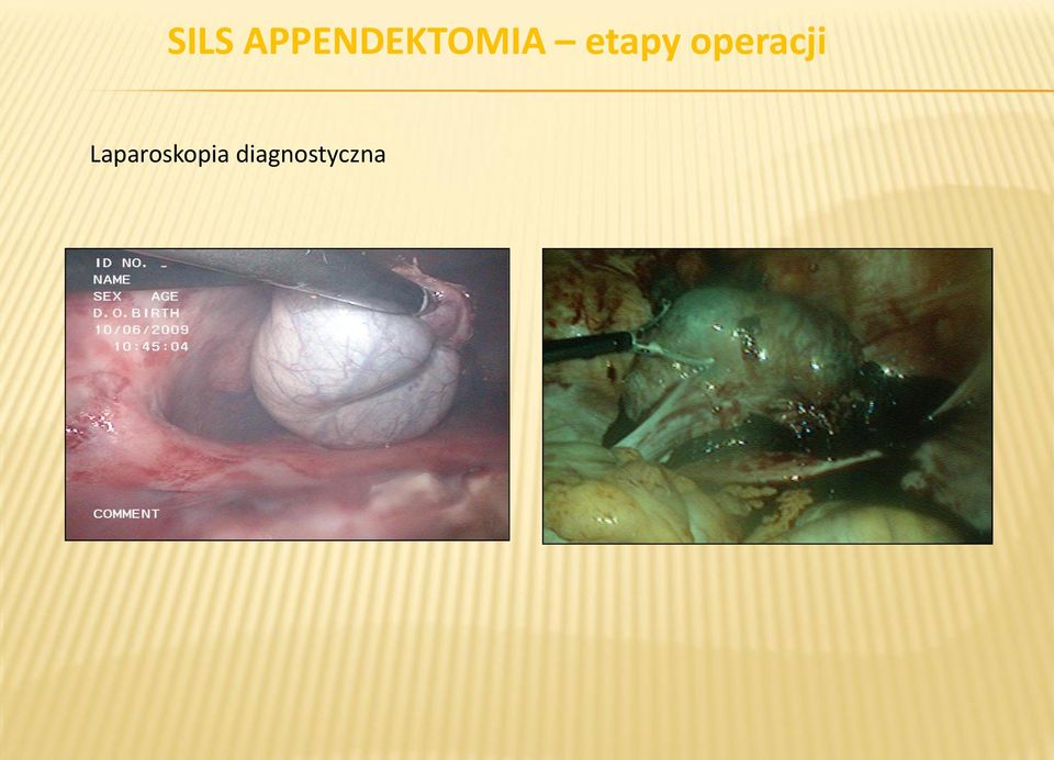 etapy operacji