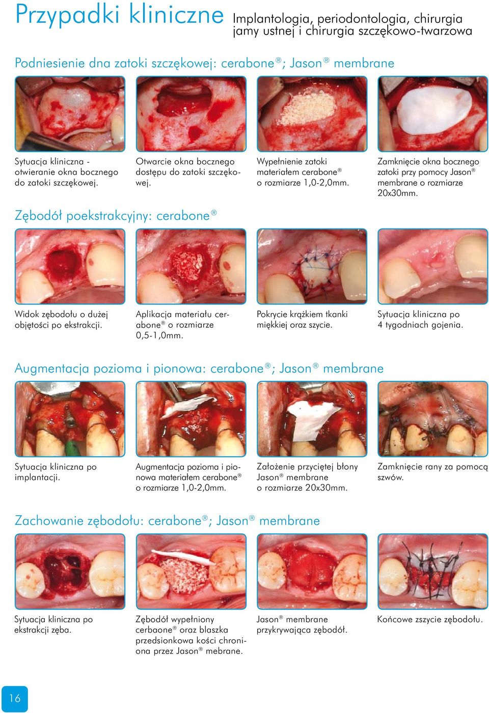 Zamknięcie okna bocznego zatoki przy pomocy Jason membrane o rozmiarze 20x30mm. Zębodół poekstrakcyjny: cerabone Widok zębodołu o dużej objętości po ekstrakcji.