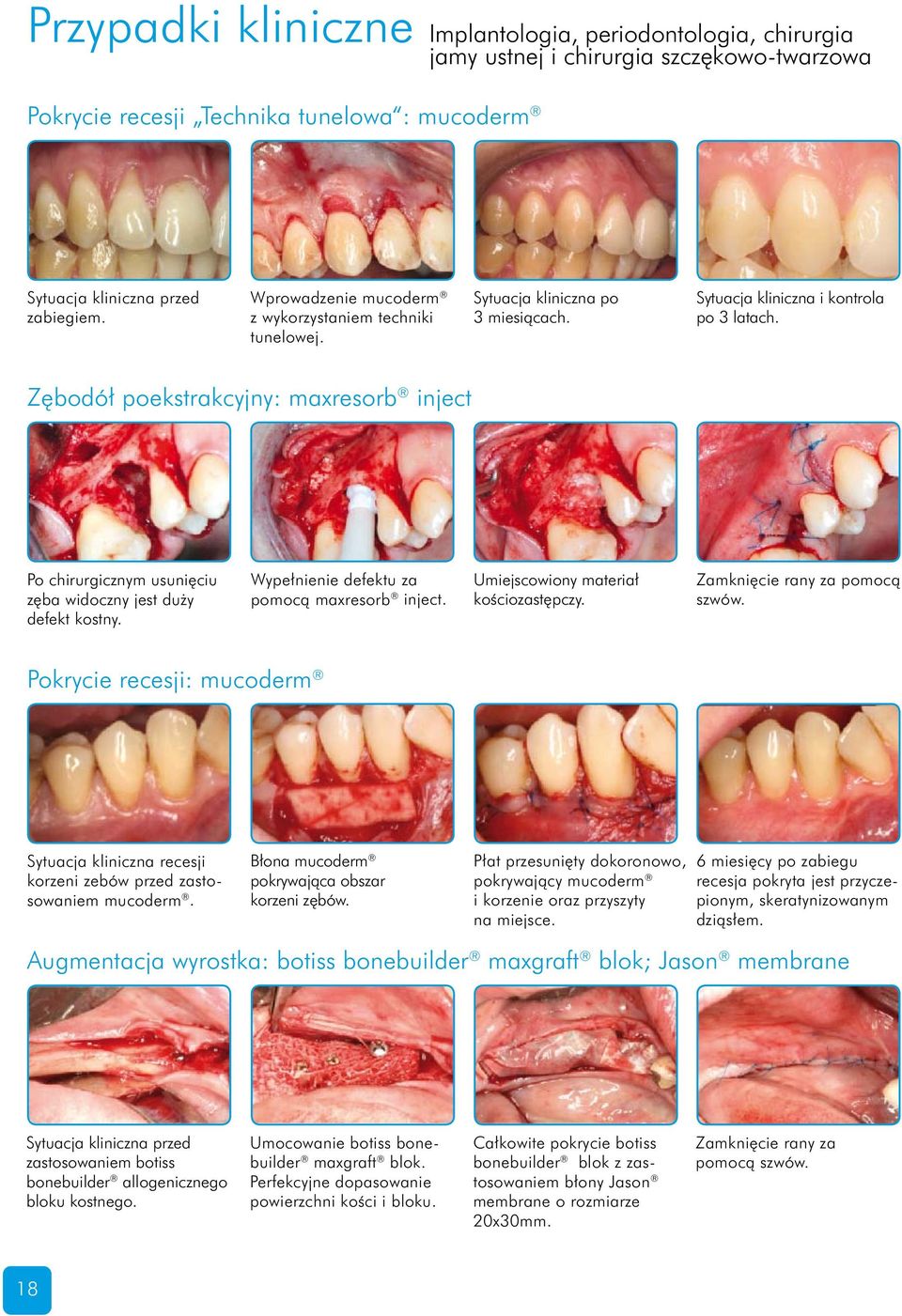 Zębodół poekstrakcyjny: maxresorb inject Po chirurgicznym usunięciu zęba widoczny jest duży defekt kostny. Wypełnienie defektu za pomocą maxresorb inject. Umiejscowiony materiał kościozastępczy.