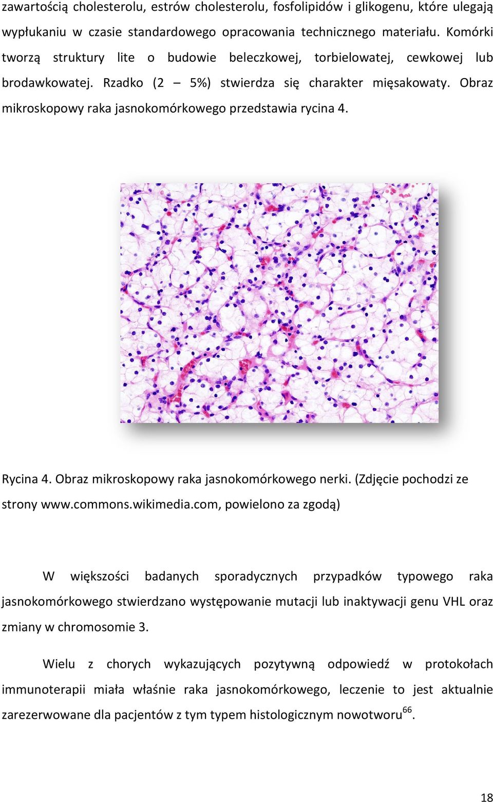 Obraz mikroskopowy raka jasnokomórkowego jasnoko przedstawia rycina 4. Rycina 4.. Obraz mikroskopowy raka jasnokomórkowego nerki. (Zdjęcie pochodzi ze strony www.commons.wikimedia.