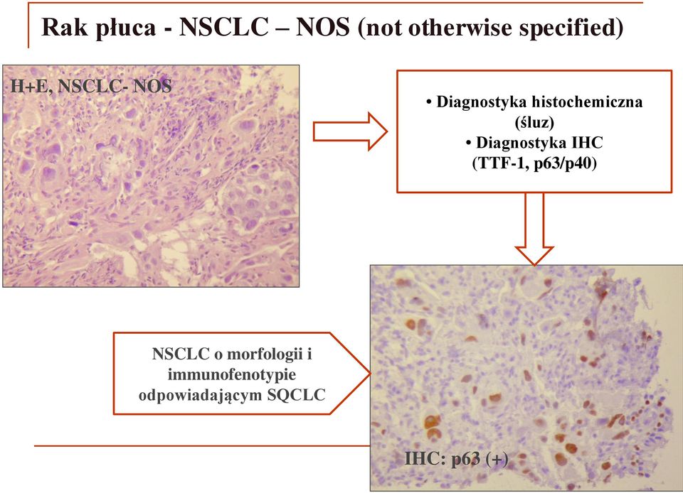 Diagnostyka IHC (TTF-1, p63/p40) NSCLC o