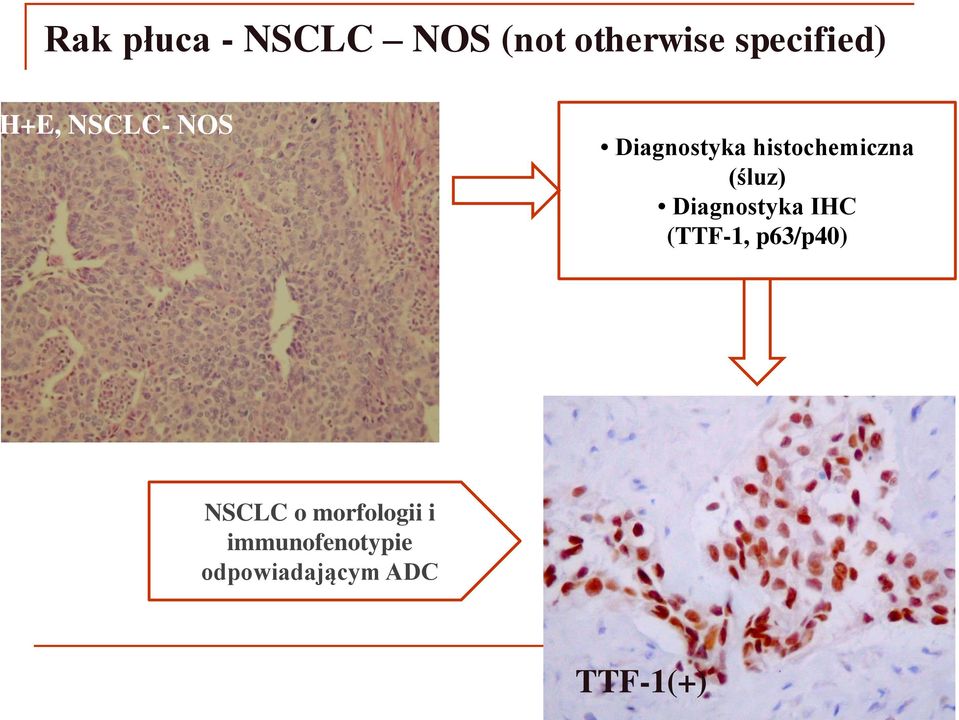 (śluz) Diagnostyka IHC (TTF-1, p63/p40) NSCLC o