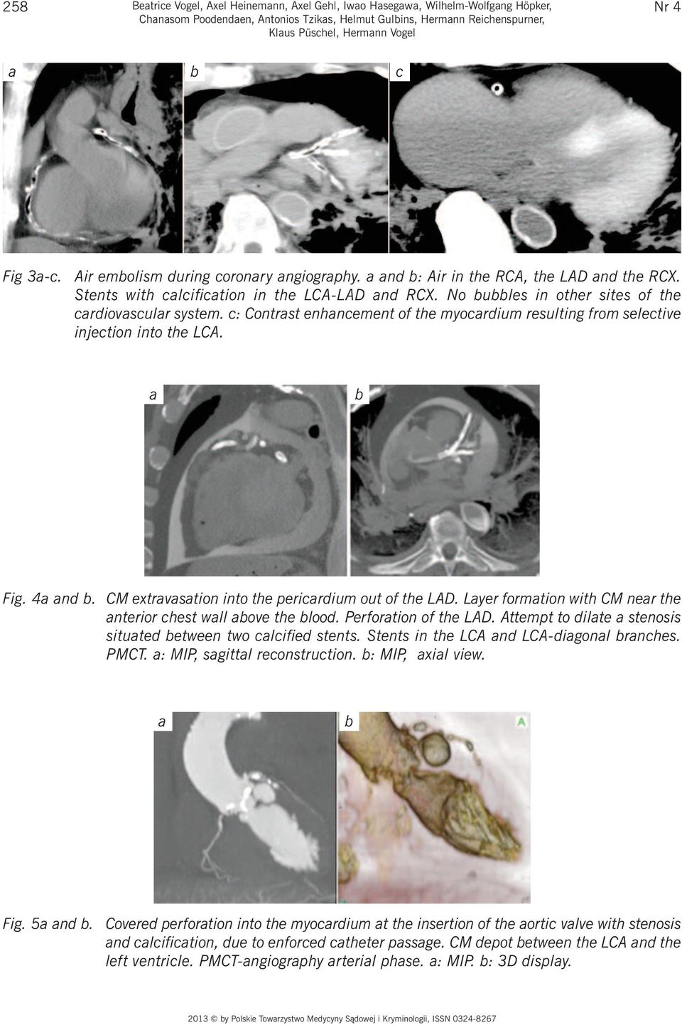 No bubbles in other sites of the cardiovascular system. c: Contrast enhancement of the myocardium resulting from selective injection into the LCA. a b Fig. 4a and b.