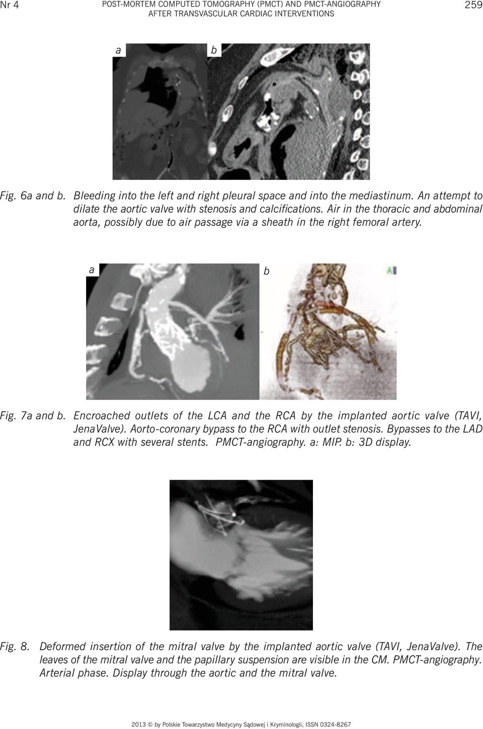 Air in the thoracic and abdominal aorta, possibly due to air passage via a sheath in the right femoral artery. a b Fig. 7a and b.