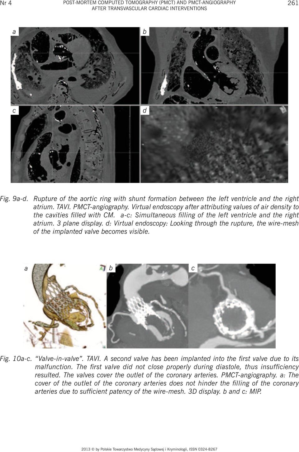 Virtual endoscopy after attributing values of air density to the cavities filled with CM. a-c: Simultaneous filling of the left ventricle and the right atrium. 3 plane display.