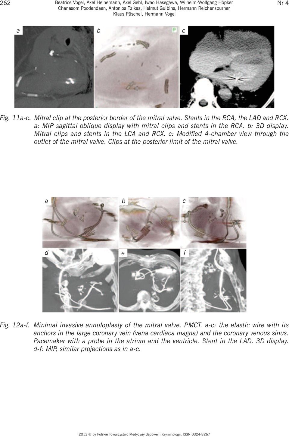 Mitral clips and stents in the LCA and RCX. c: Modified 4-chamber view through the outlet of the mitral valve. Clips at the posterior limit of the mitral valve. a b c d e f Fig. 12a-f.