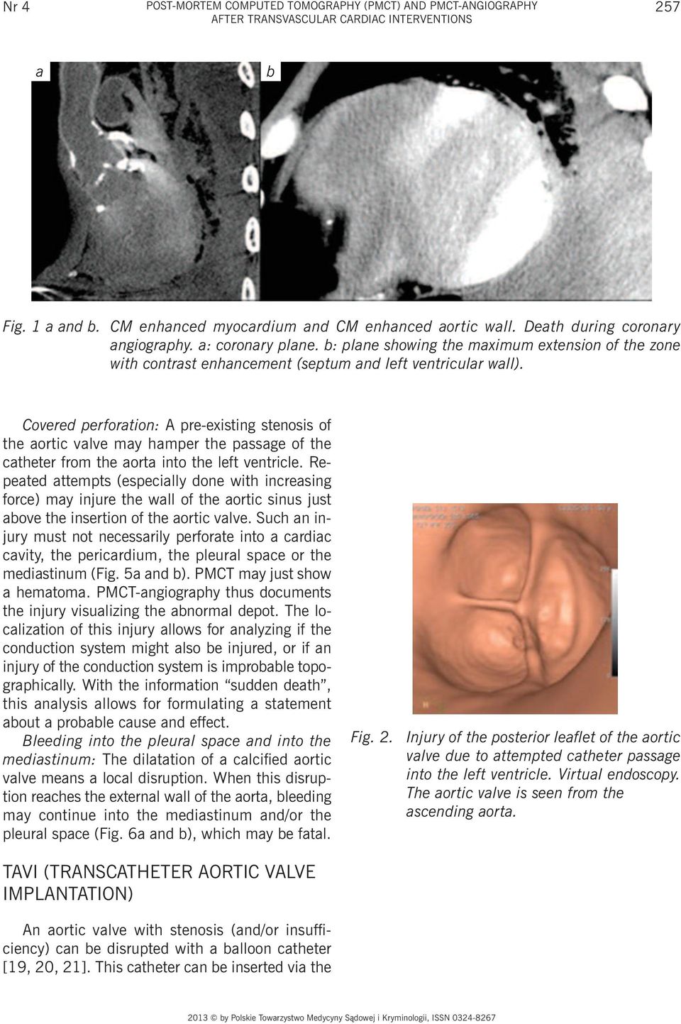 Covered perforation: A pre-existing stenosis of the aortic valve may hamper the passage of the catheter from the aorta into the left ventricle.