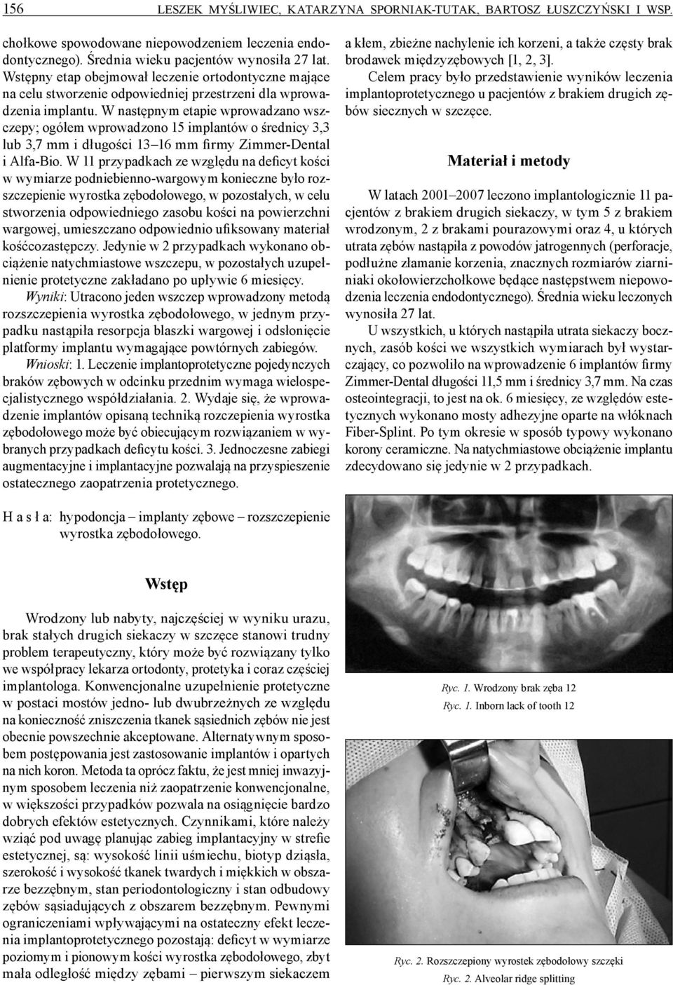 W następnym etapie wprowadzano wszczepy; ogółem wprowadzono 15 implantów o średnicy 3,3 lub 3,7 mm i długości 13 16 mm firmy Zimmer-Dental i Alfa-Bio.