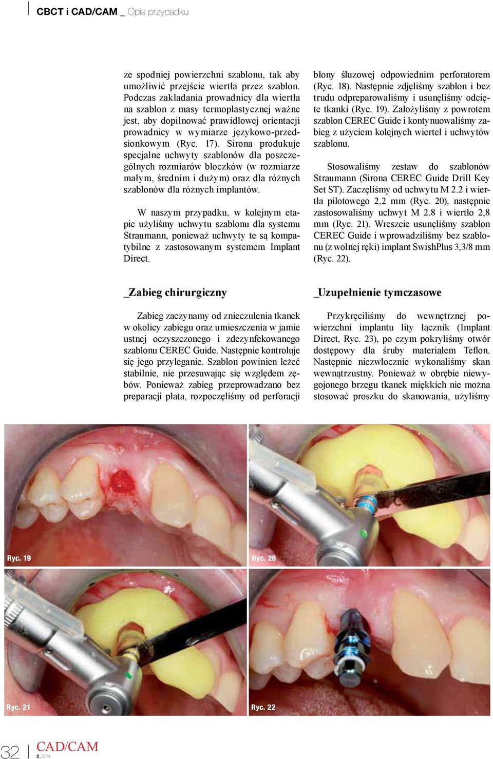 Sirona produkuje specjalne uchwyty szablonów dla poszczególnych rozmiarów bloczków (w rozmiarze małym, średnim i dużym) oraz dla różnych szablonów dla różnych implantów.