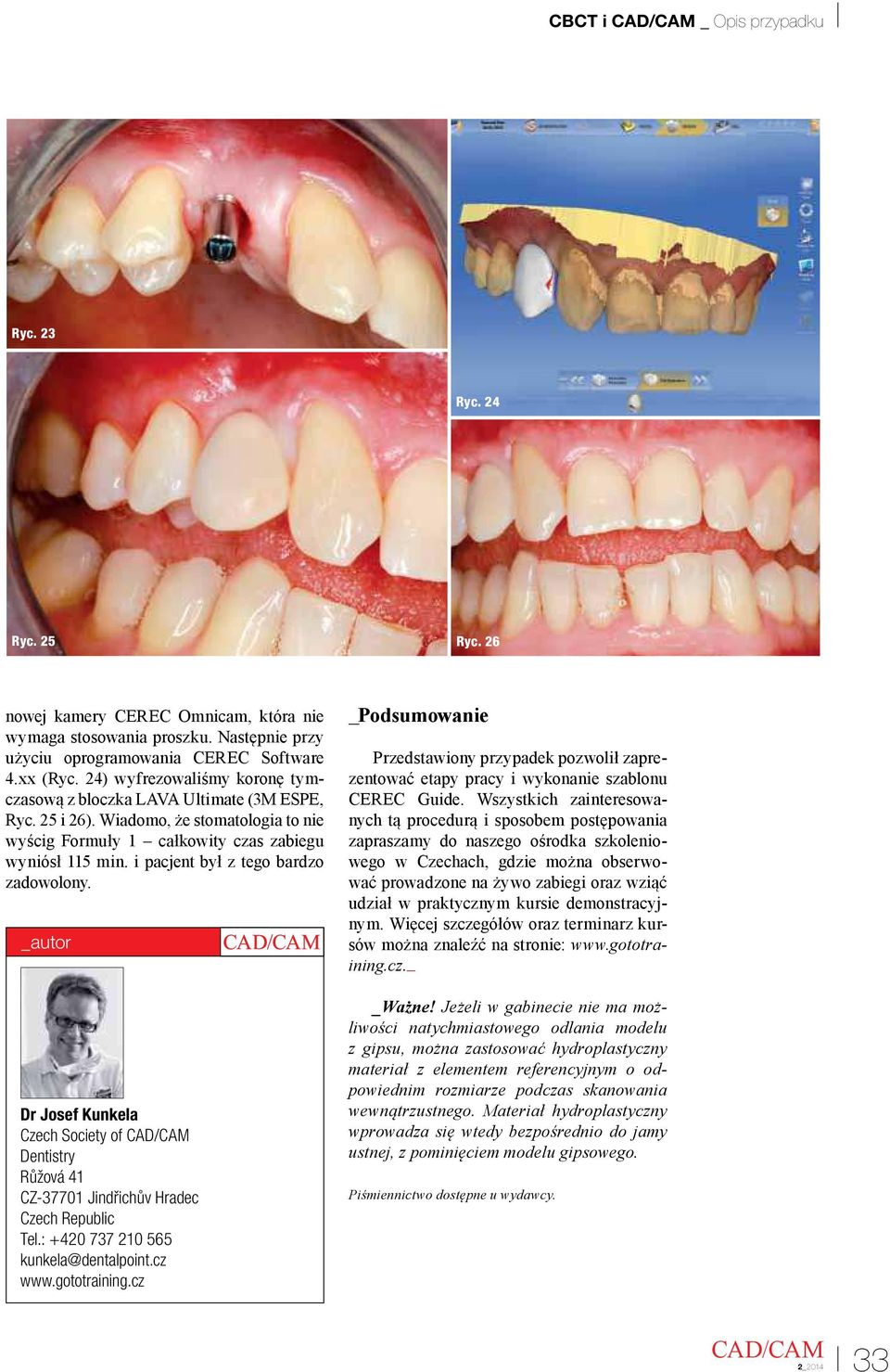 i pacjent był z tego bardzo zadowolony. _autor Dr Josef Kunkela Czech Society of Dentistry Růžová 41 CZ-37701 Jindřichův Hradec Czech Republic Tel.: +420 737 210 565 kunkela@dentalpoint.cz www.