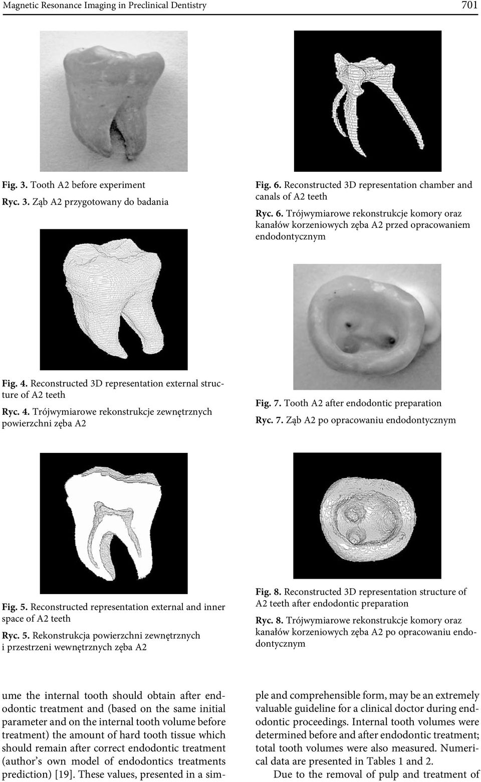 Reconstructed 3D representation external structure of A2 teeth Ryc. 4. Trójwymiarowe rekonstrukcje zewnętrznych powierzchni zęba A2 Fig. 7. Tooth A2 after endodontic preparation Ryc. 7. Ząb A2 po opracowaniu endodontycznym Fig.