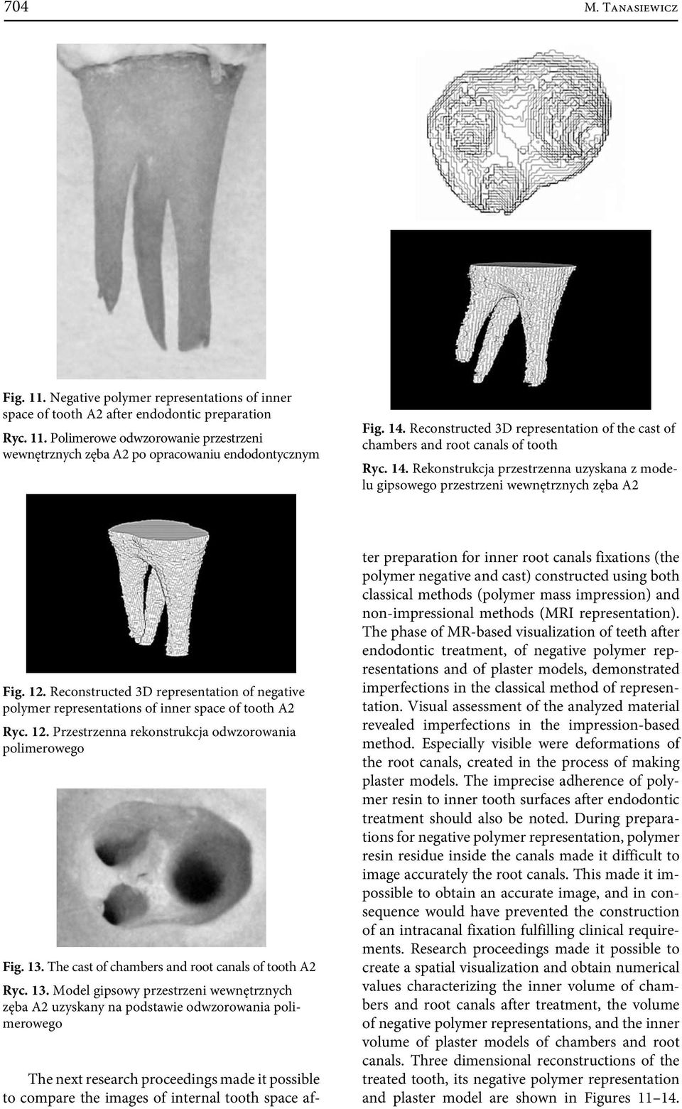 Reconstructed 3D representation of negative polymer representations of inner space of tooth A2 Ryc. 12. Przestrzenna rekonstrukcja odwzorowania polimerowego Fig. 13.