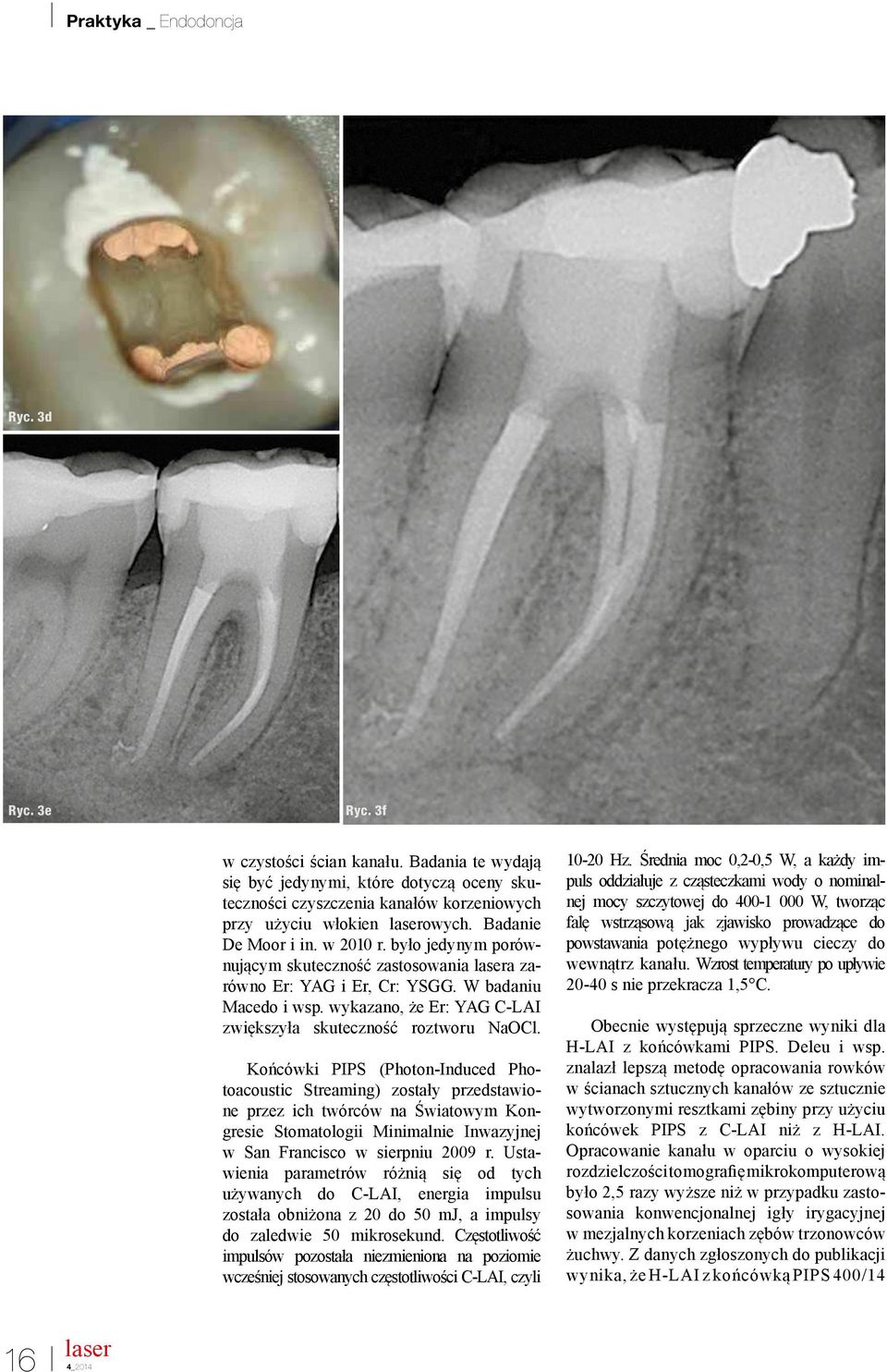 Końcówki PIPS (Photon-Induced Photoacoustic Streaming) zostały przedstawione przez ich twórców na Światowym Kongresie Stomatologii Minimalnie Inwazyjnej w San Francisco w sierpniu 2009 r.