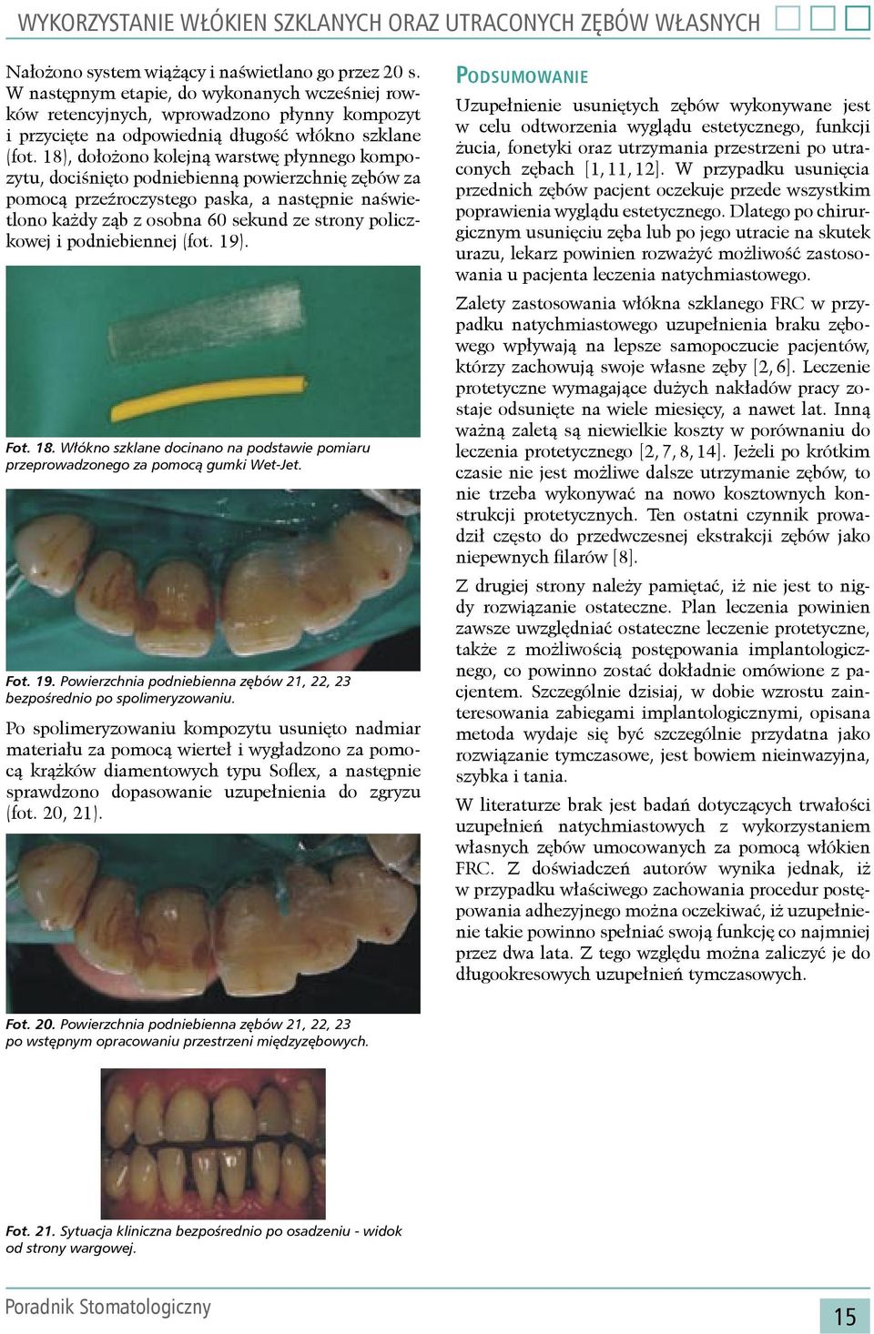 18), dołożono kolejną warstwę płynnego kompozytu, dociśnięto podniebienną powierzchnię zębów za pomocą przeźroczystego paska, a następnie naświetlono każdy ząb z osobna 60 sekund ze strony