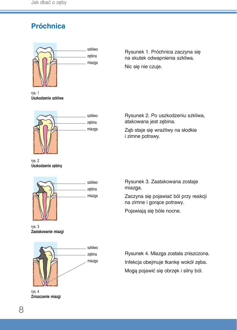 2 Uszkodzenie zębiny szkliwo zębina miazga Rysunek 3. Zaatakowana zostaje miazga. Zaczyna się pojawiać ból przy reakcji na zimne i gorące potrawy.