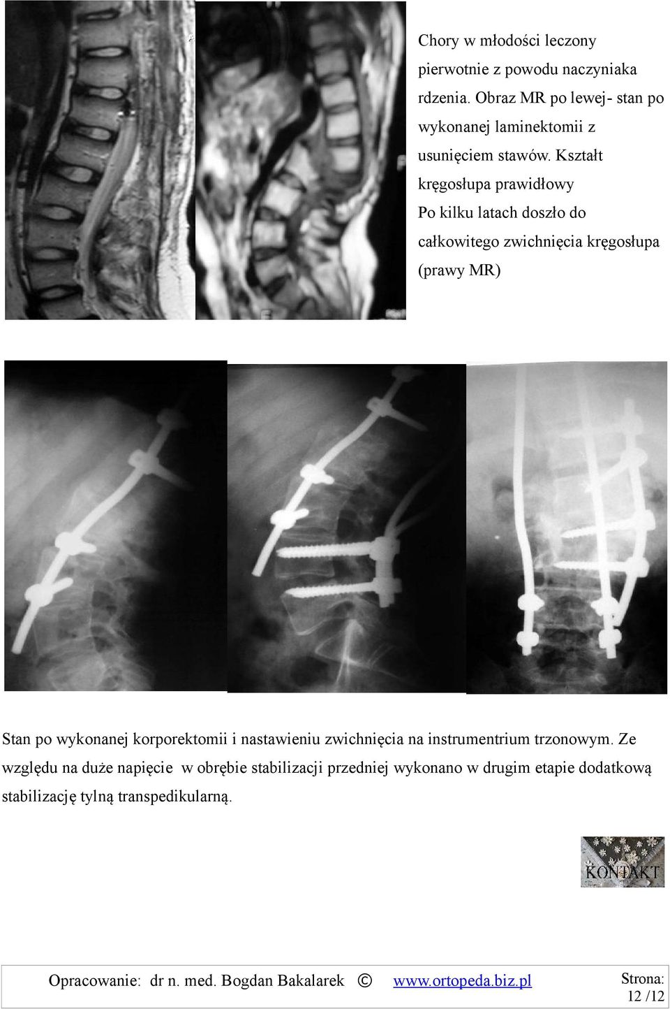Kształt kręgosłupa prawidłowy Po kilku latach doszło do całkowitego zwichnięcia kręgosłupa (prawy MR) Stan po wykonanej korporektomii