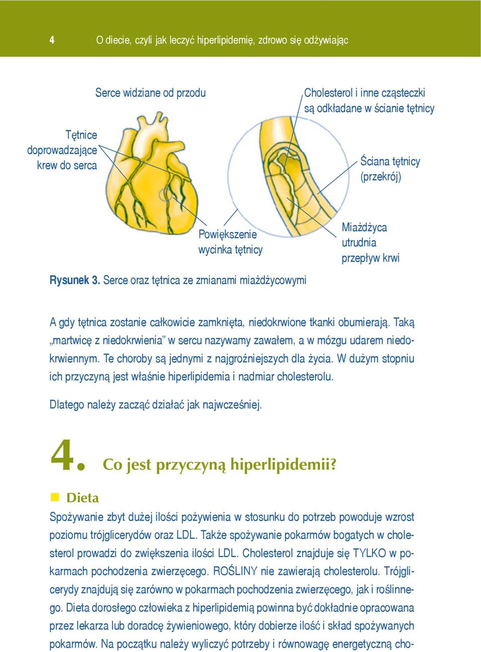 Serce oraz têtnica ze zmianami mia d ycowymi A gdy têtnica zostanie ca³kowicie zamkniêta, niedokrwione tkanki obumieraj¹.