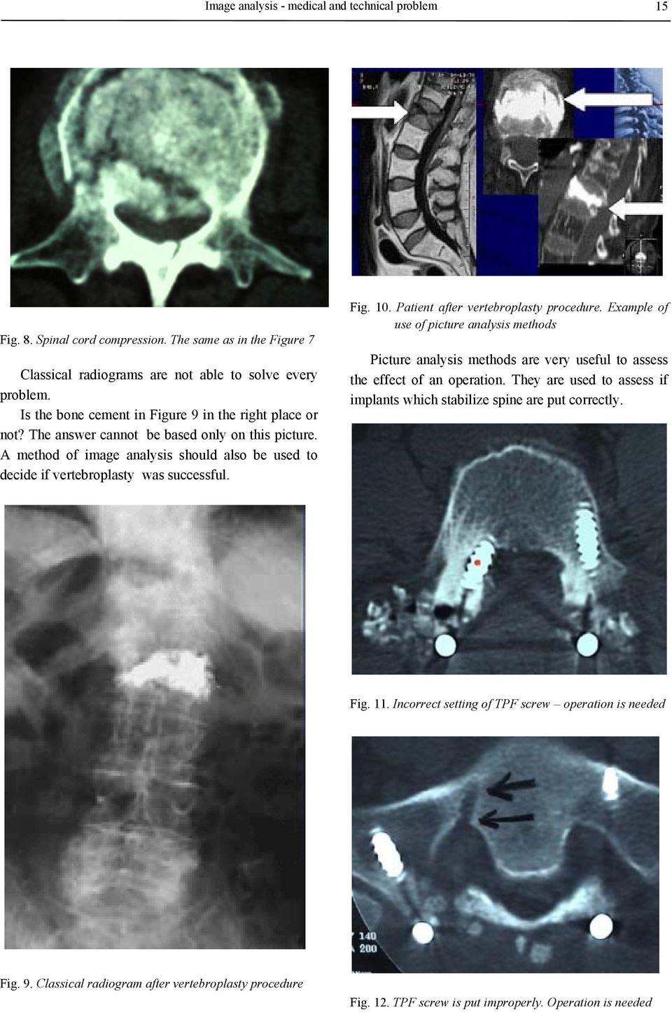 Fig. 10. Patient after vertebroplasty procedure. Example of use of picture analysis methods Picture analysis methods are very useful to assess the effect of an operation.