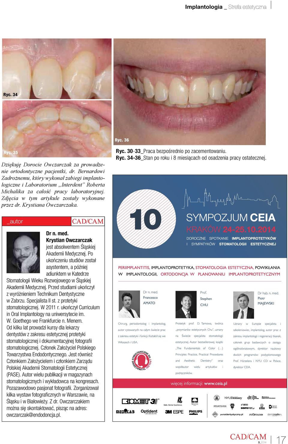 Krystiana Owczarczaka. Ryc. 30-33_Praca bezpośrednio po zacementowaniu. Ryc. 34-36_Stan po roku i 8 miesiącach od osadzenia pracy ostatecznej. _autor Dr n. med.