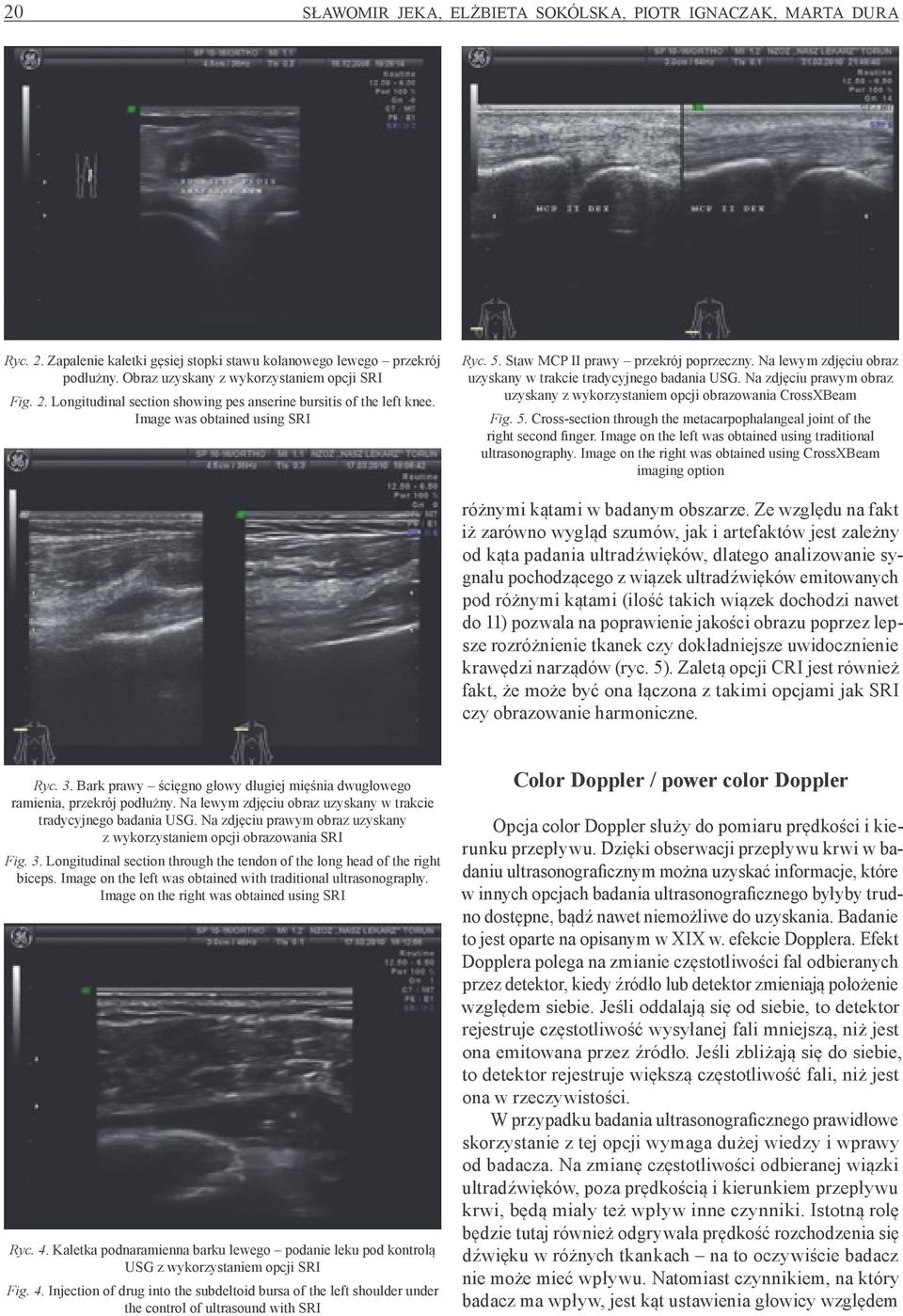 Na zdjęciu prawym obraz uzyskany z wykorzystaniem opcji obrazowania CrossXBeam Fig. 5. Cross -section through the metacarpophalangeal joint of the right second finger.