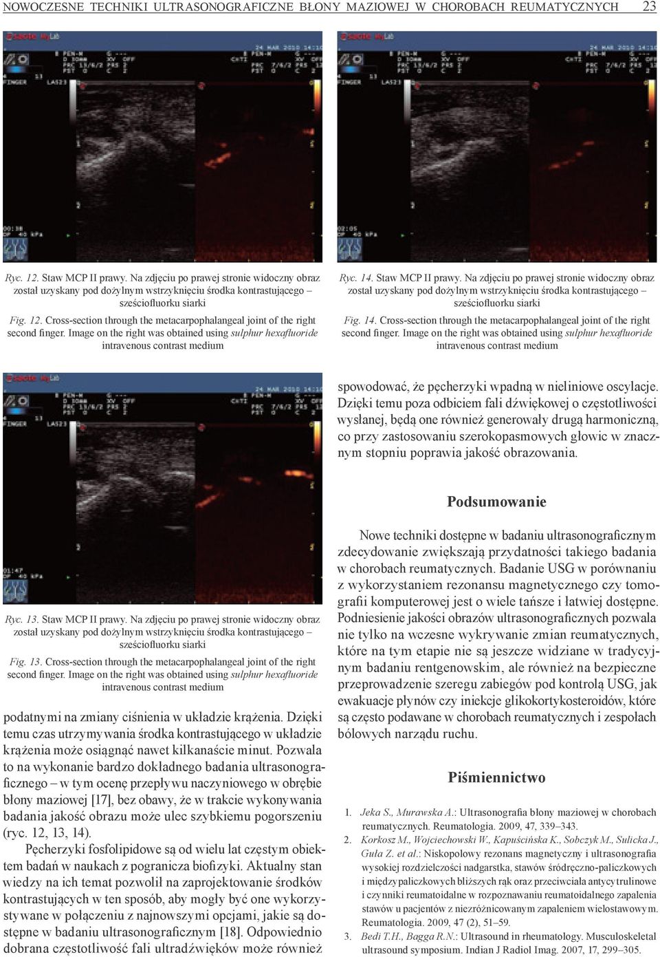 Cross -section through the metacarpophalangeal joint of the right second finger. Image on the right was obtained using sulphur hexafl uoride intravenous contrast medium Ryc. 14. Staw MCP II prawy.