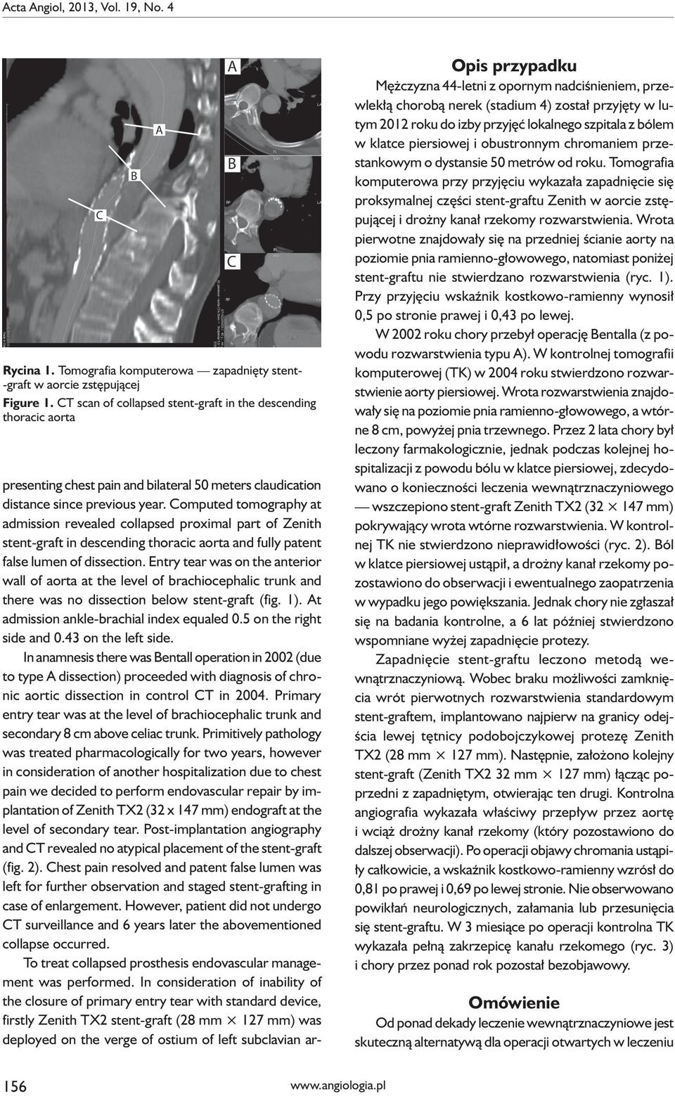 Computed tomography at admission revealed collapsed proximal part of Zenith stent-graft in descending thoracic aorta and fully patent false lumen of dissection.