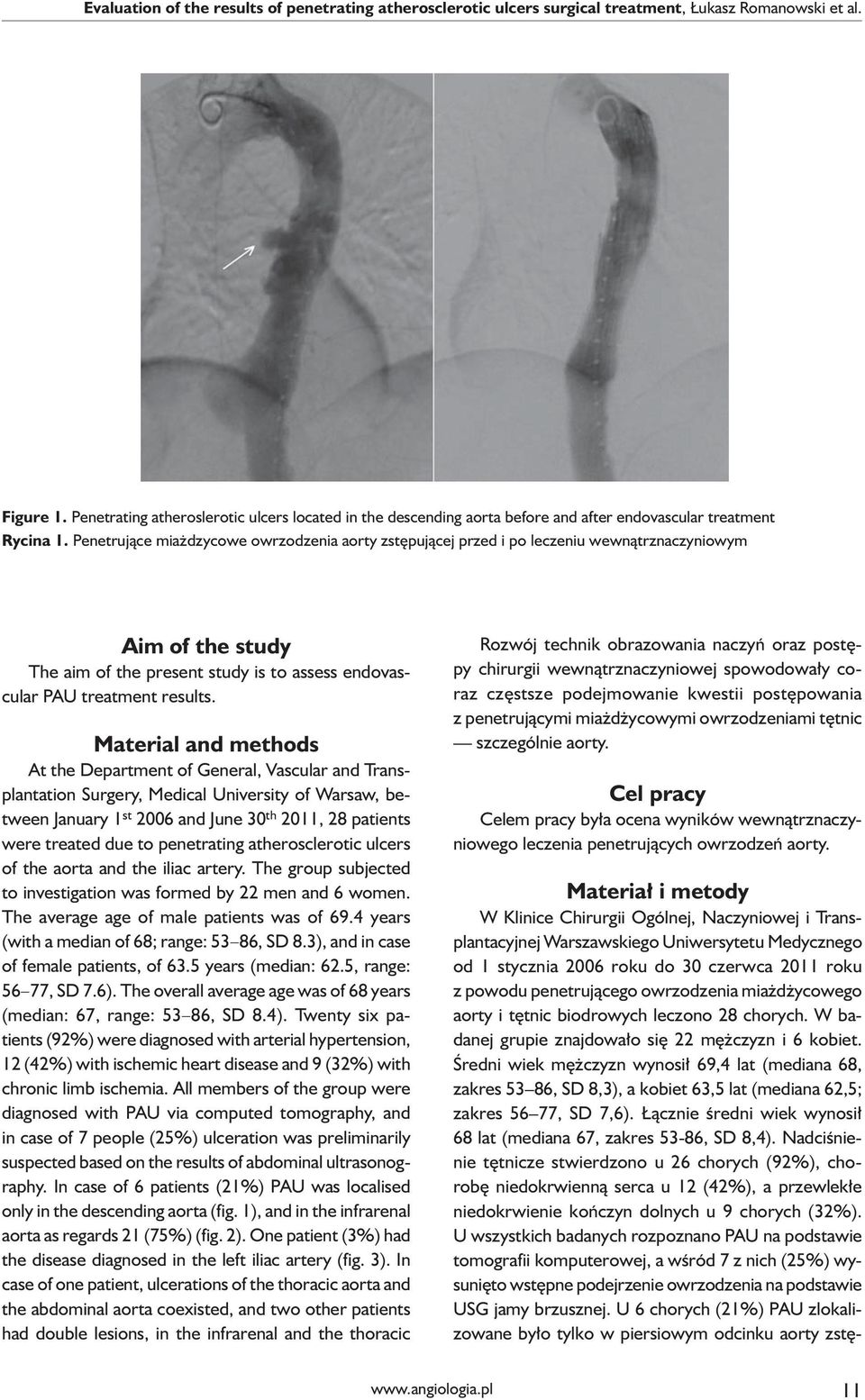 Penetrujące miażdzycowe owrzodzenia aorty zstępującej przed i po leczeniu wewnątrznaczyniowym Aim of the study The aim of the present study is to assess endovascular PAU treatment results.