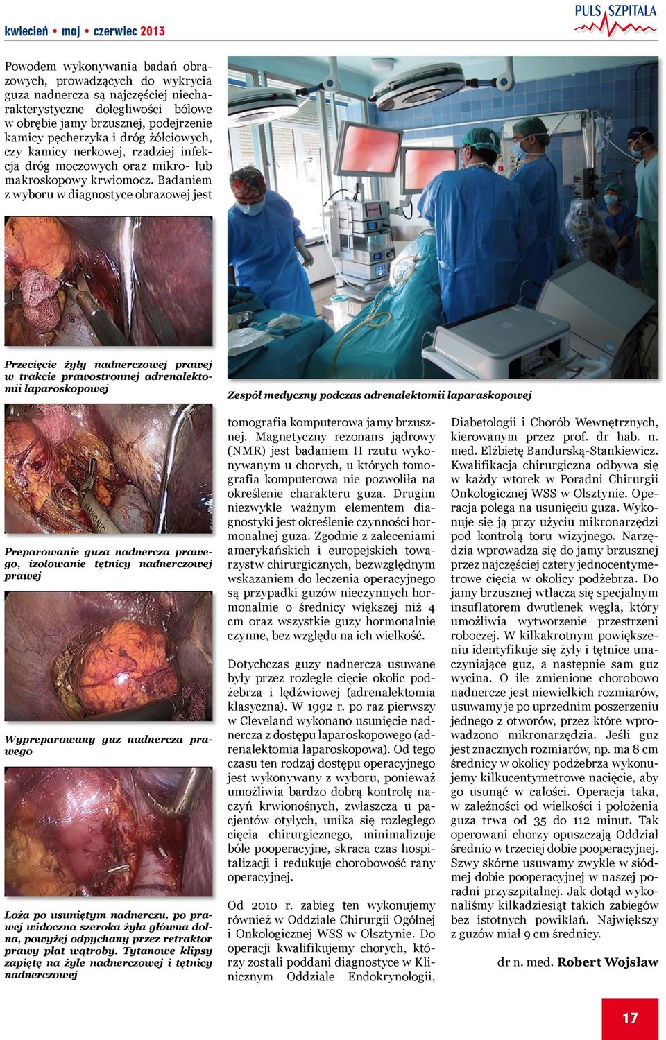 Badaniem z wyboru w diagnostyce obrazowej jest Przecięcie żyły nadnerczowej prawej w trakcie prawostronnej adrenalektomii laparoskopowej Zespół medyczny podczas adrenalektomii laparaskopowej