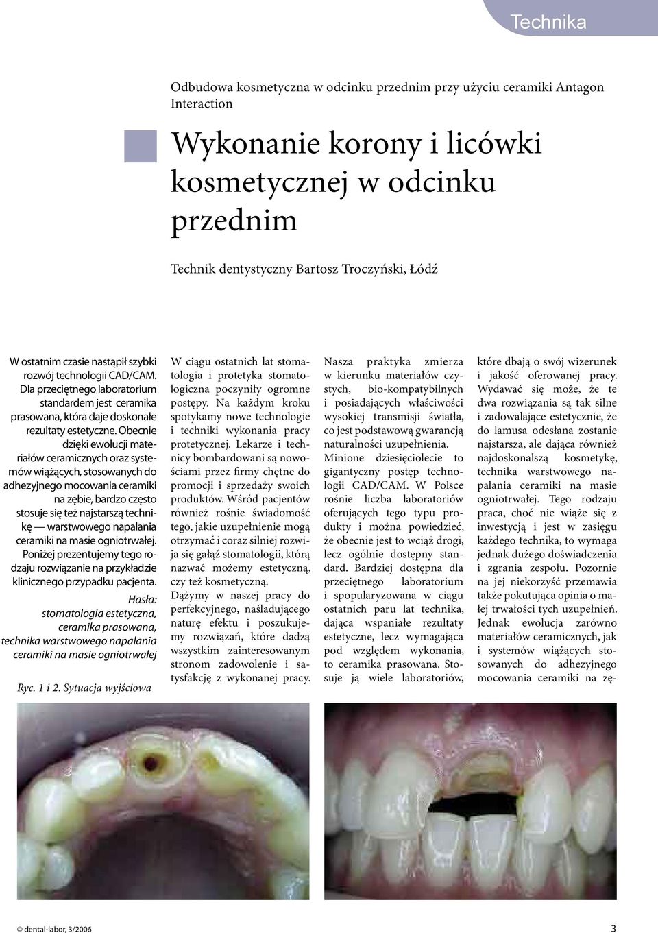 Obecnie dzięki ewolucji materiałów ceramicznych oraz systemów wiążących, stosowanych do adhezyjnego mocowania ceramiki na zębie, bardzo często stosuje się też najstarszą technikę warstwowego