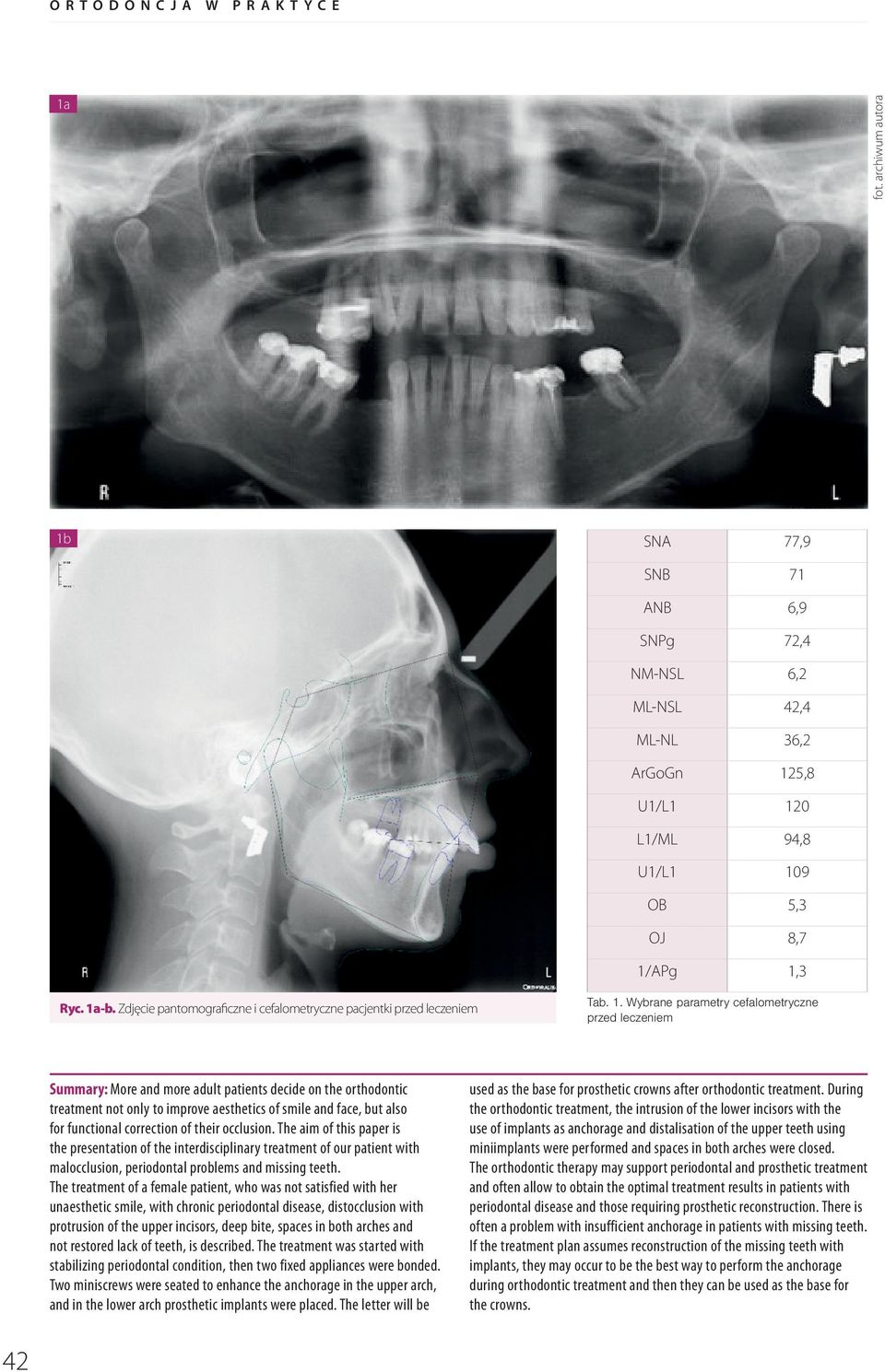 Wybrane parametry cefalometryczne przed leczeniem Summary: More and more adult patients decide on the orthodontic treatment not only to improve aesthetics of smile and face, but also for functional