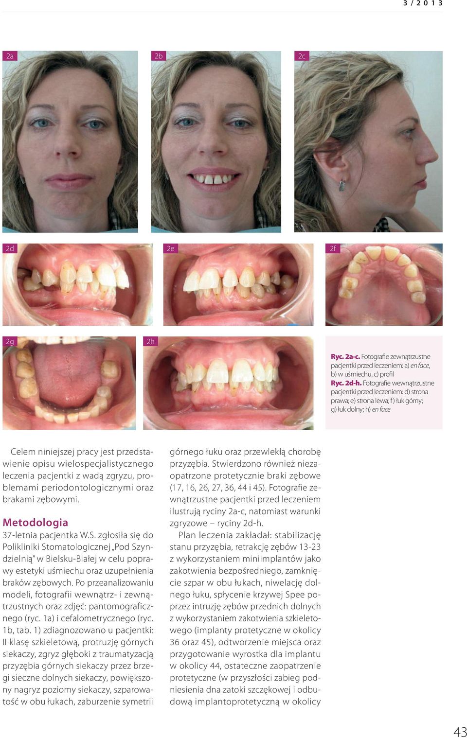 leczenia pacjentki z wadą zgryzu, problemami periodontologicznymi oraz brakami zębowymi. Metodologia 37-letnia pacjentka W.S.