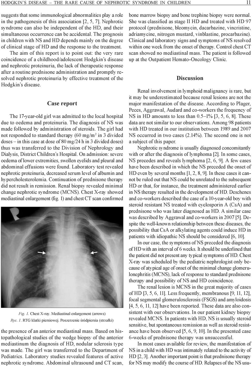 The prognosis in children with NS and HD depends mainly on the degree of clinical stage of HD and the response to the treatment.