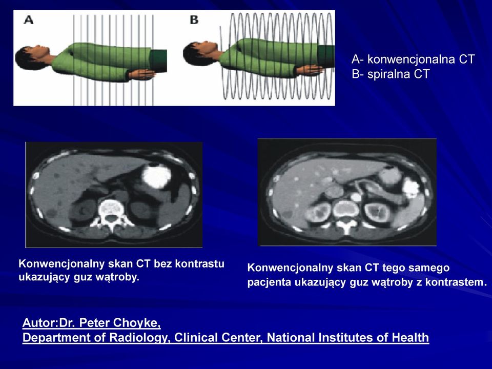 Konwencjonalny skan CT tego samego pacjenta ukazujący guz wątroby z